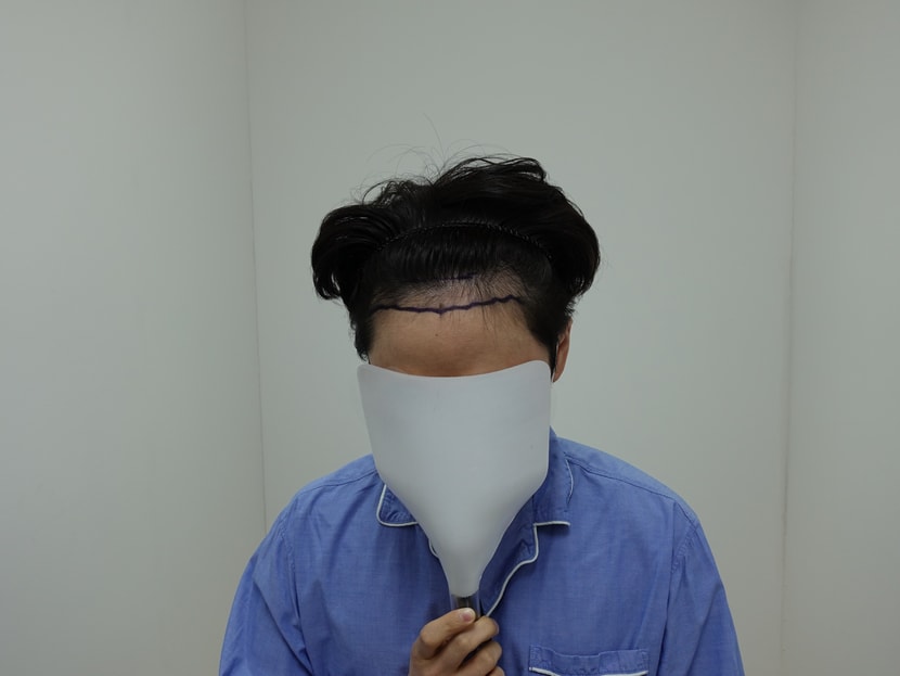 1년전 수술전 넓은 이마와 살짝 m자 모습이 있던 때