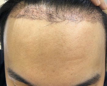 이식부위27일차