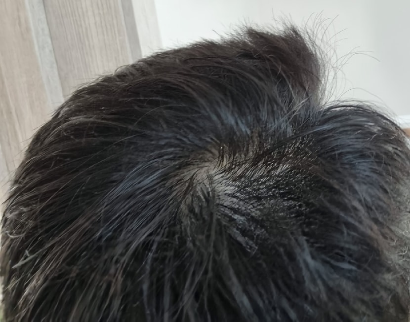 수술 전 머리감고 올리는 기록용 사진!
