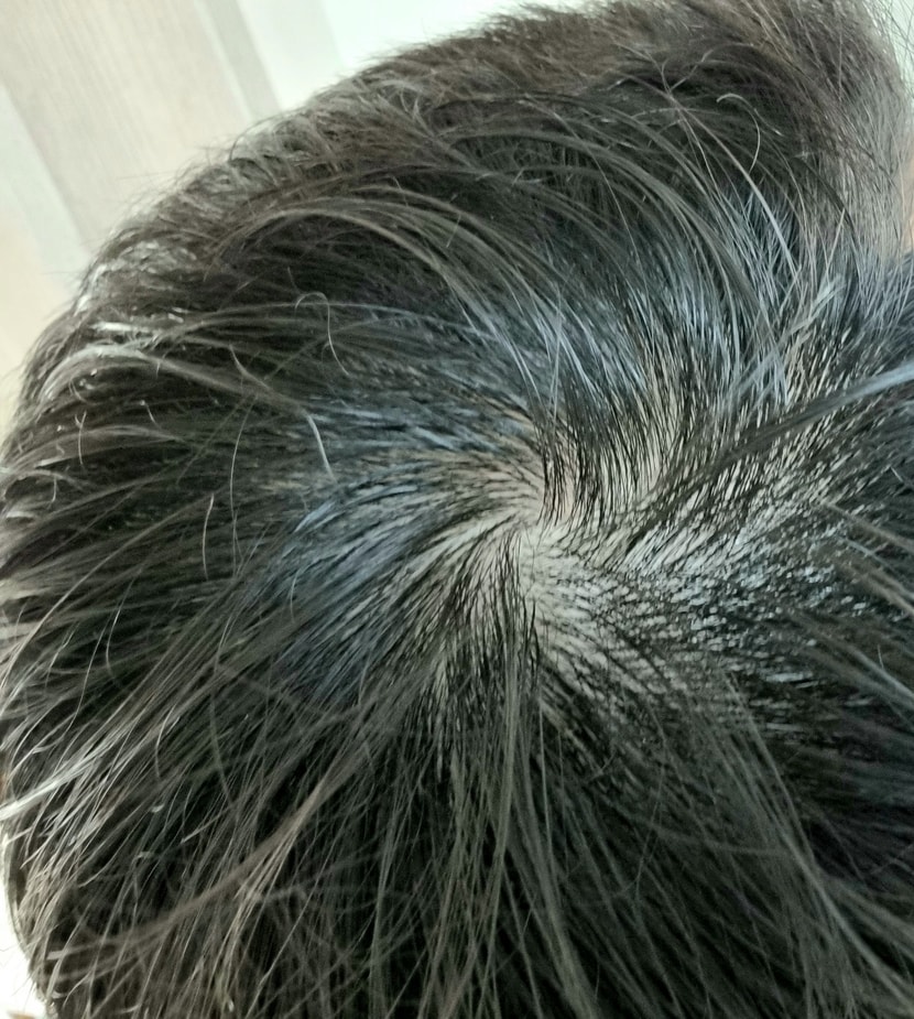 수술 전 머리감고 올리는 기록용 사진!