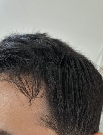 수술 전 머리감고 올리는 기록용 사진!