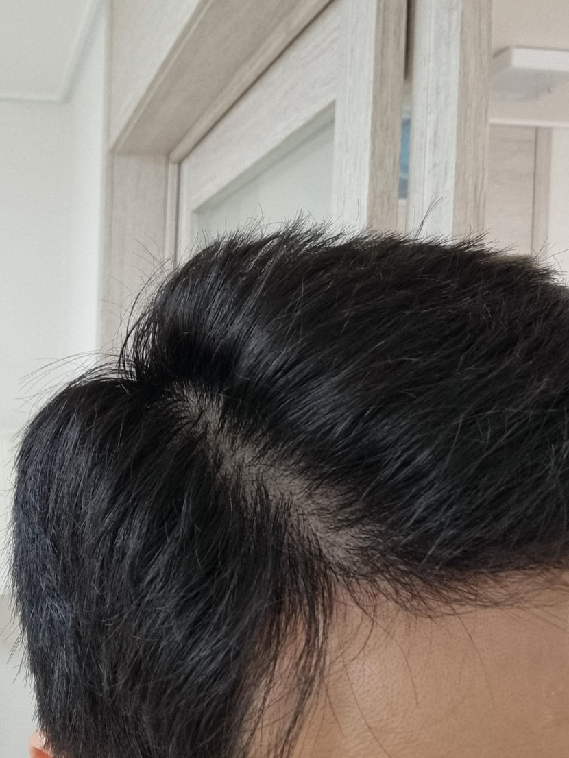 수술 전 머리감고 올리는 기록용 사진!