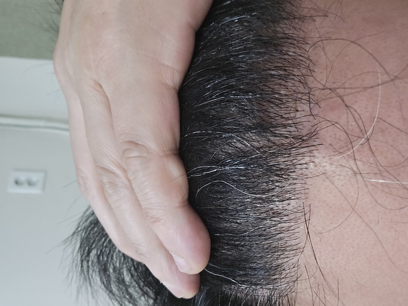 이번 사진은 지금 현재 6개월 후에 이식후 사진입니다.