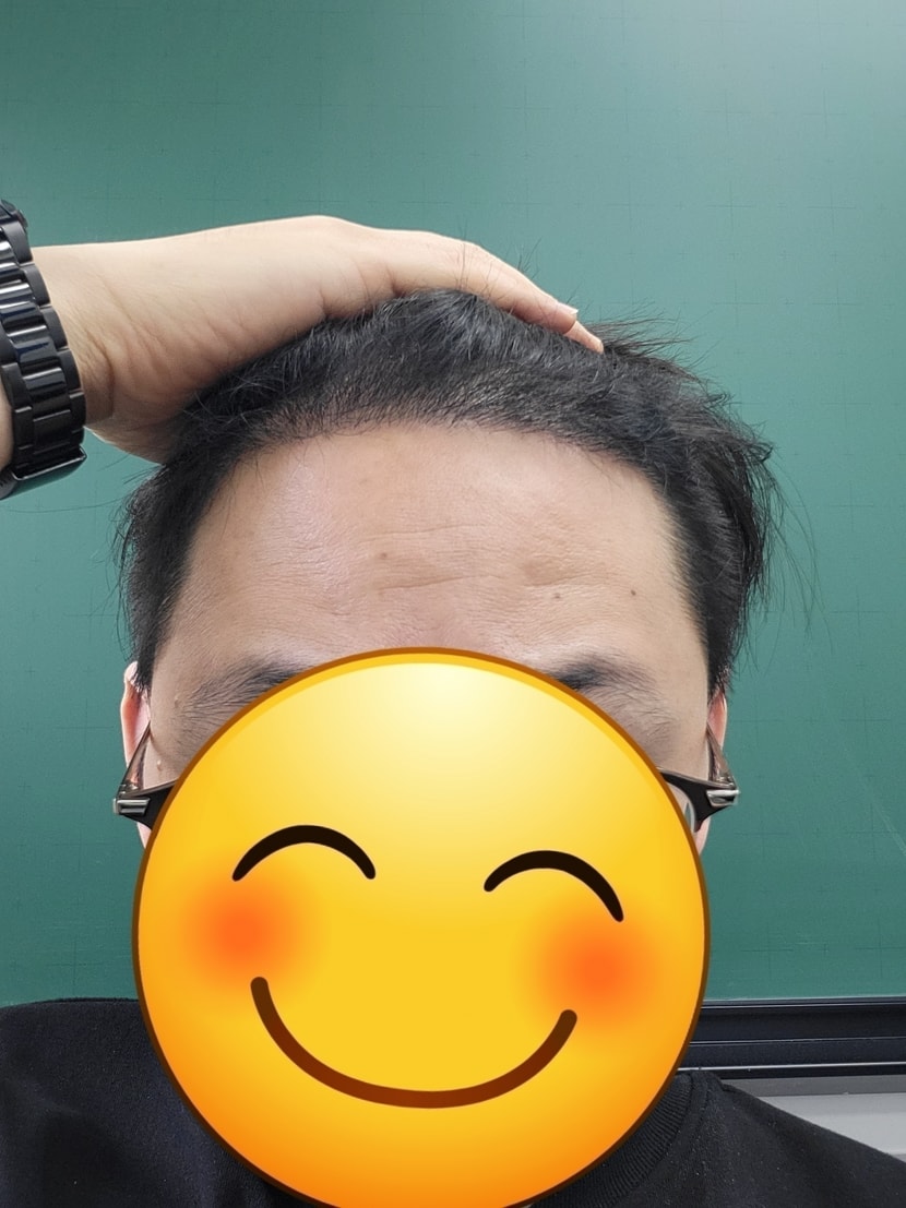수술후 5개월차