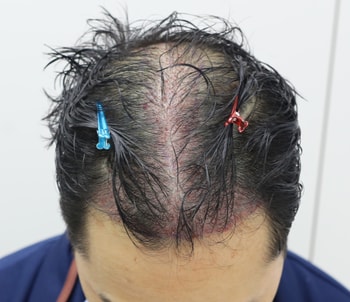 시술 후 사진