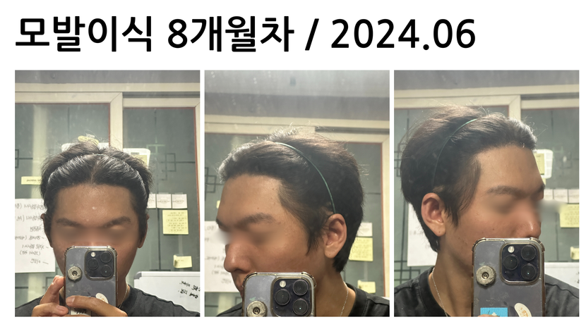 모발이식 8개월차 / 2024.06