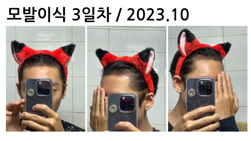 모발이식 3일차 / 2023.10