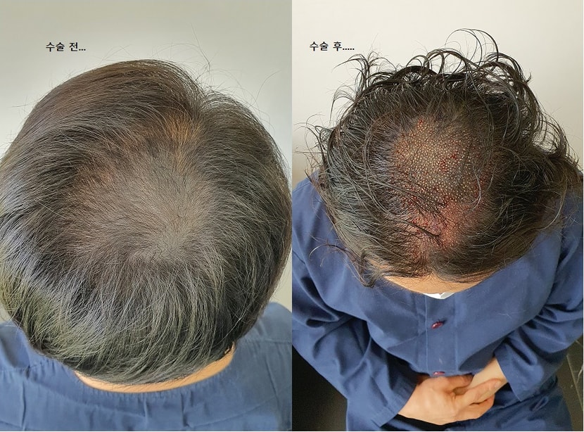 수술당일 전과 후사진입니다.