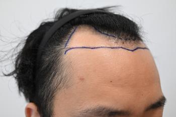 수술전 오른쪽