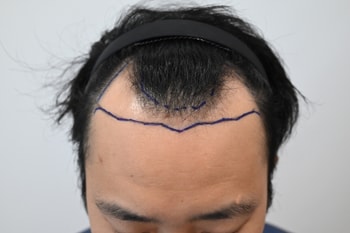 수술전 위쪽
