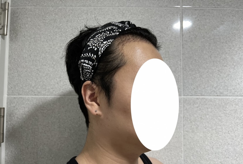 수술 후 3주 차