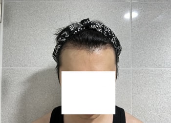 수술 후 3주 차