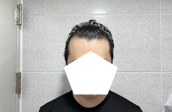 수술 전