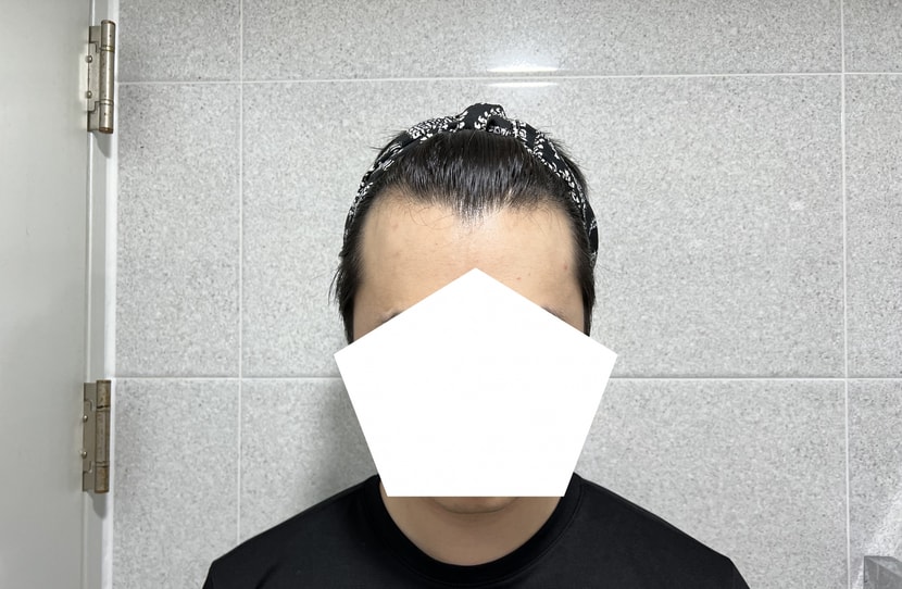 수술 전