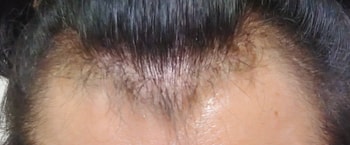 수술직전