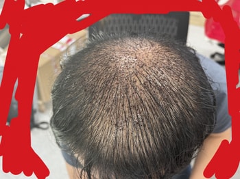 수술 직후