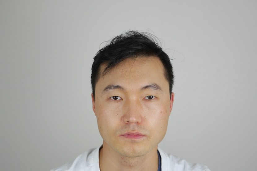 시술후1년
