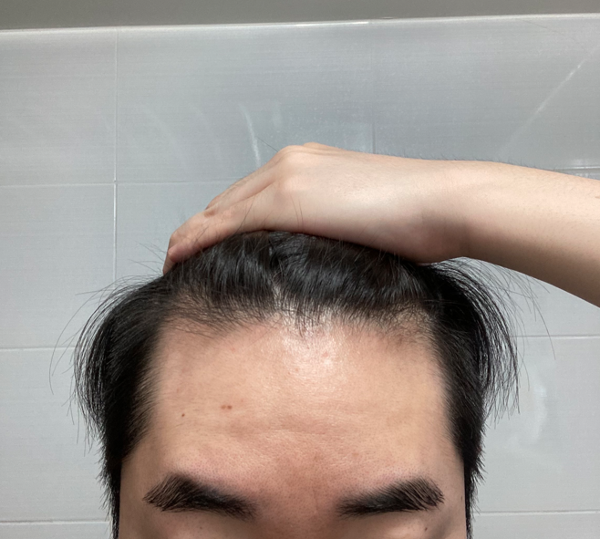수술 전