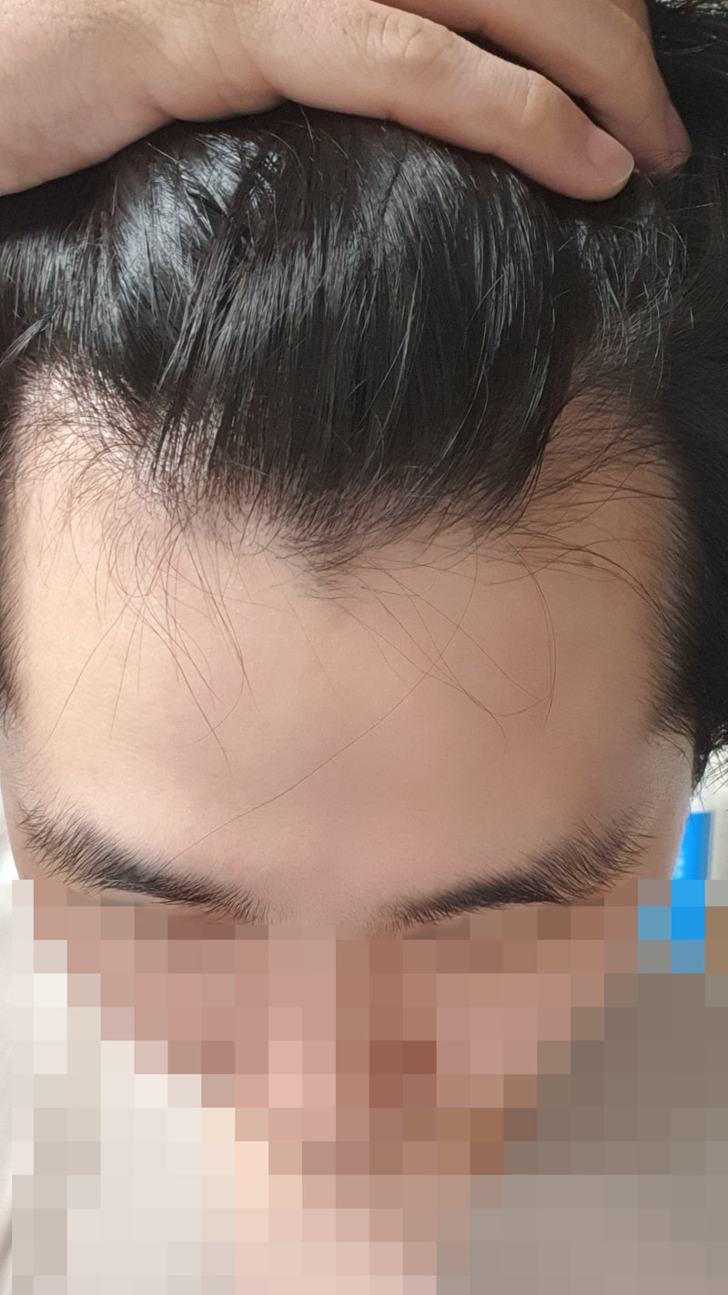 모발이식 3일차 입니다.