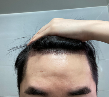 수술 3일차