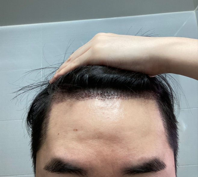 수술 3일차