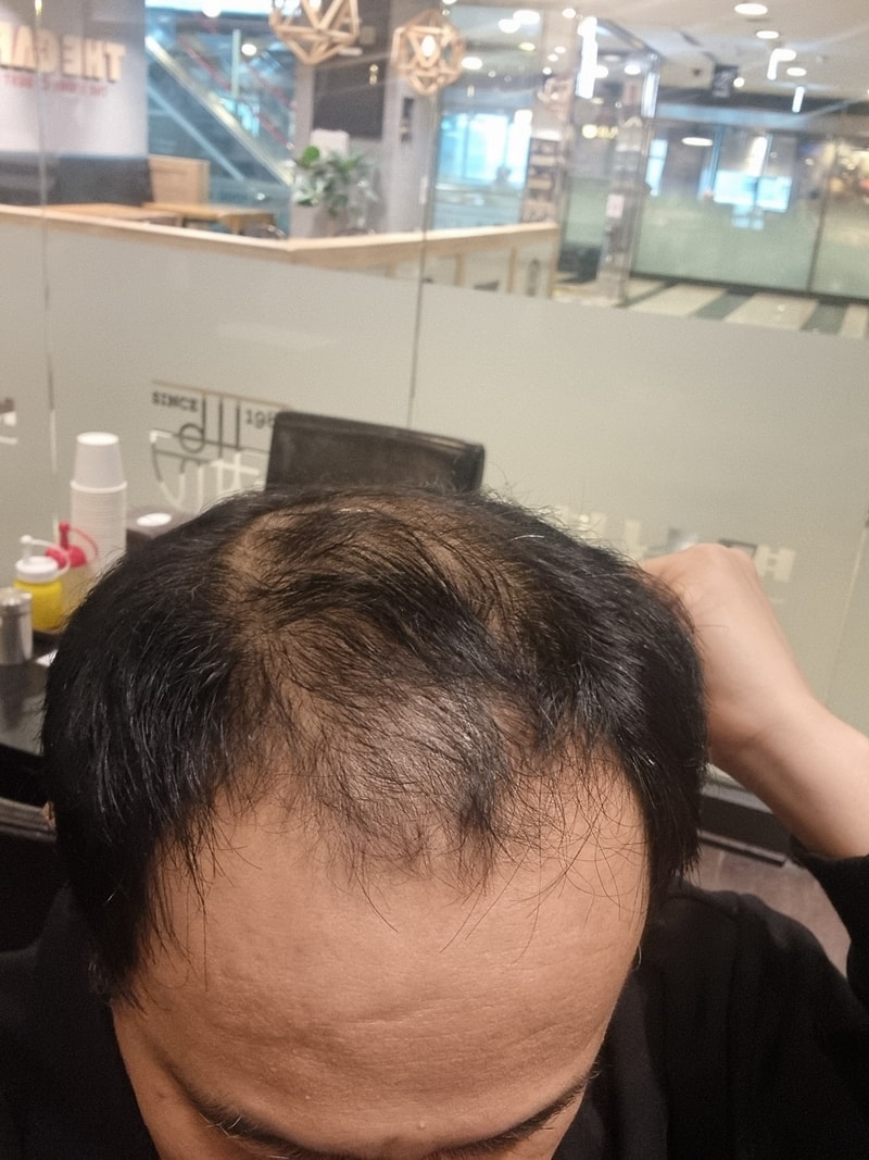 모발이식