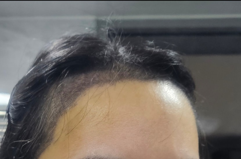 수술 8일차- 이마에 멍