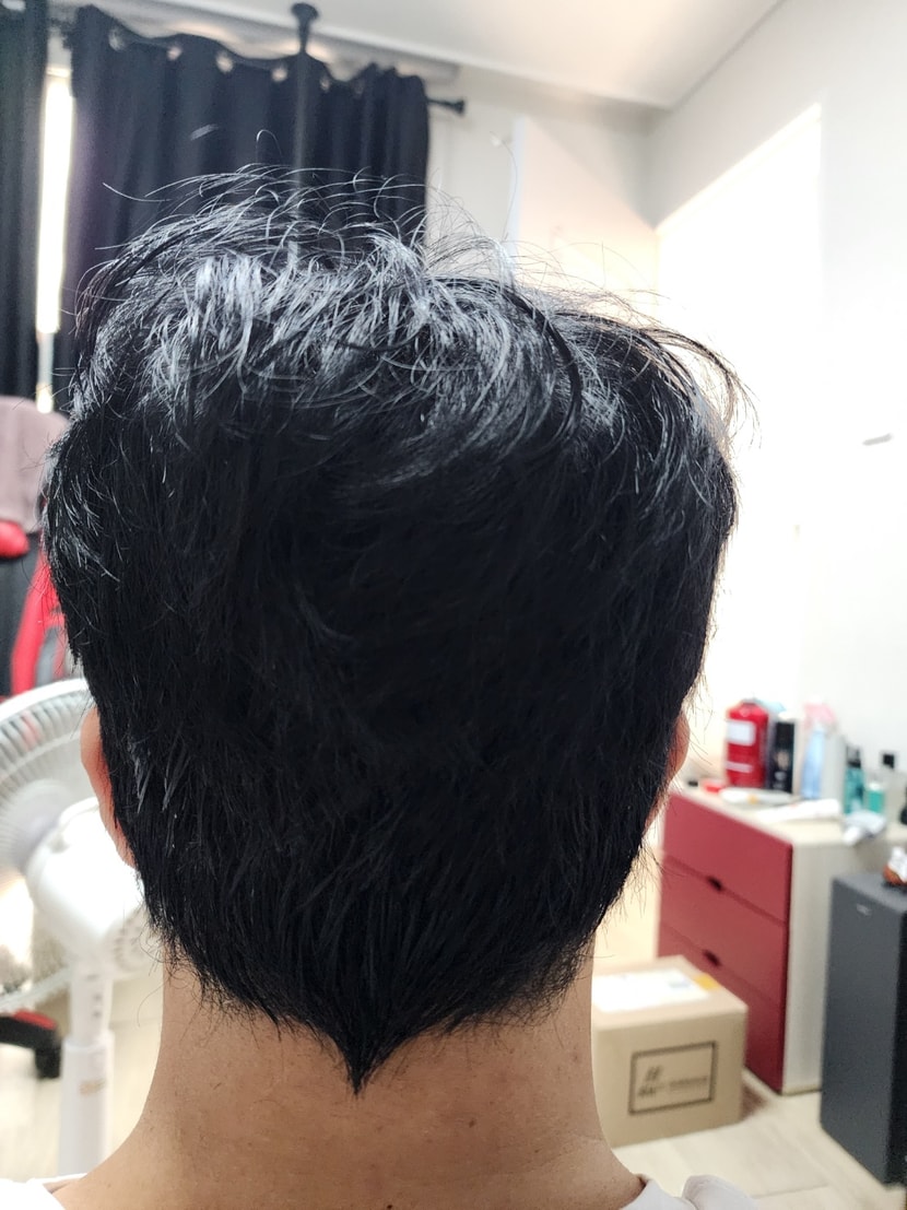 모발이식 2주차
