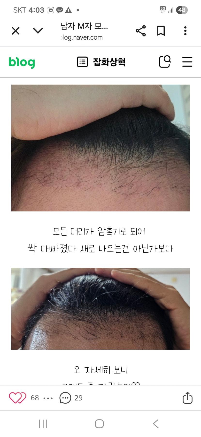 이분이 성공 케이스중 하난데  위 2달차 밑 2달 1주 혹은 10일 지난 상태 보면  검은 점 음영들과 솜털들이 보임  이런 분들이 6개월 이후에 완전 풍성 해짐 9개월이면 거의 완성형 되고 1년 지나면 말할 것도 없고  특징이 있음 뒷머리 숱이 겁나 많고 두꺼움   모낭 하나당 3개 짜리 2개 짜리 4개짜리 1개짜리 섞어 이식 받음   모낭 하나당 개수도 3 개 2 개 4개에 모발도 굵음  