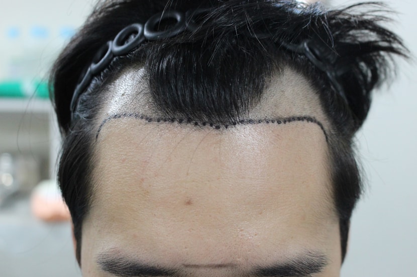 수술 전