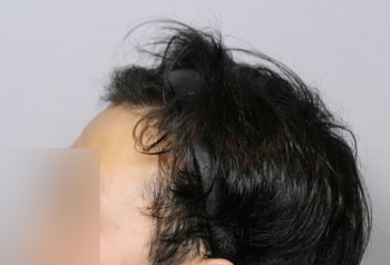 수술후