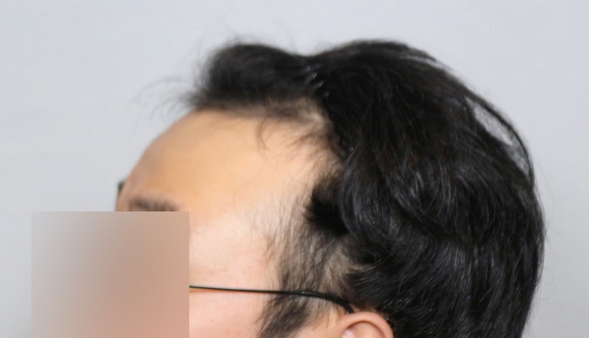 수술전