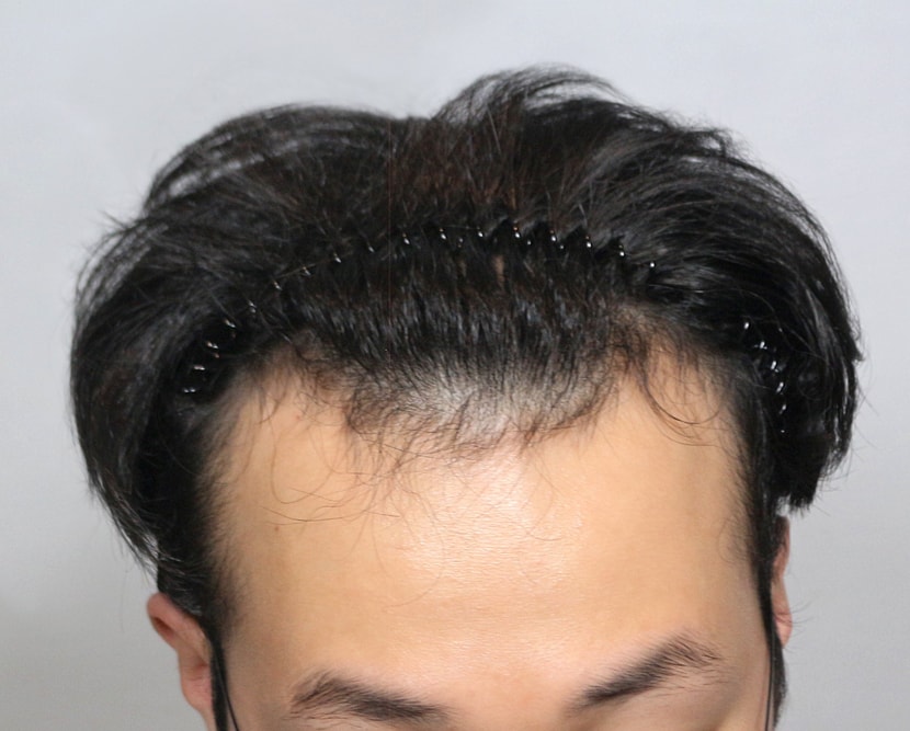 수술전