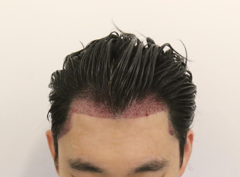 수술후