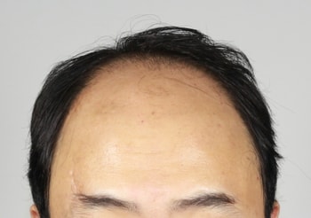 &lt; 수술전 &gt;