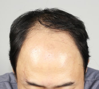 &lt; 수술전3 &gt;