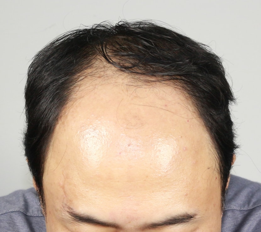 &lt; 수술전3 &gt;