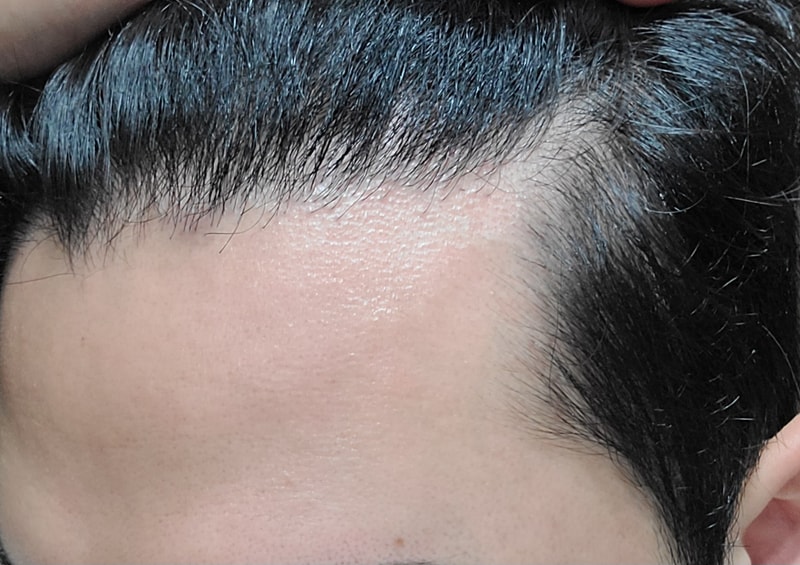 植发后过了8个月左右,移植毛发卷曲太严重了,所以很苦恼。