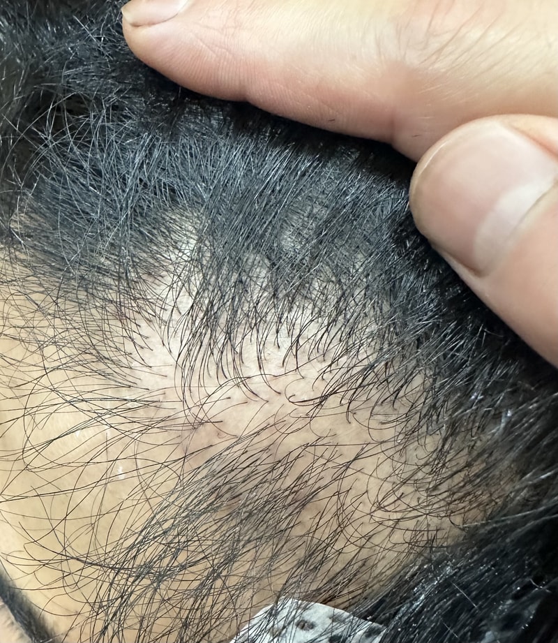 [移植失败] 切开 5千毛 8个月大