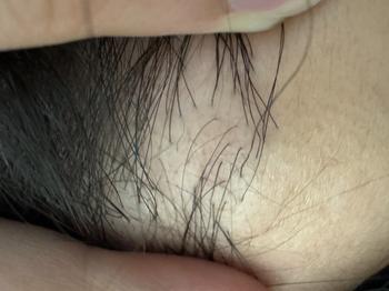 구레나룻 이식 사진