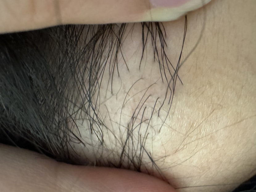 구레나룻 이식 사진