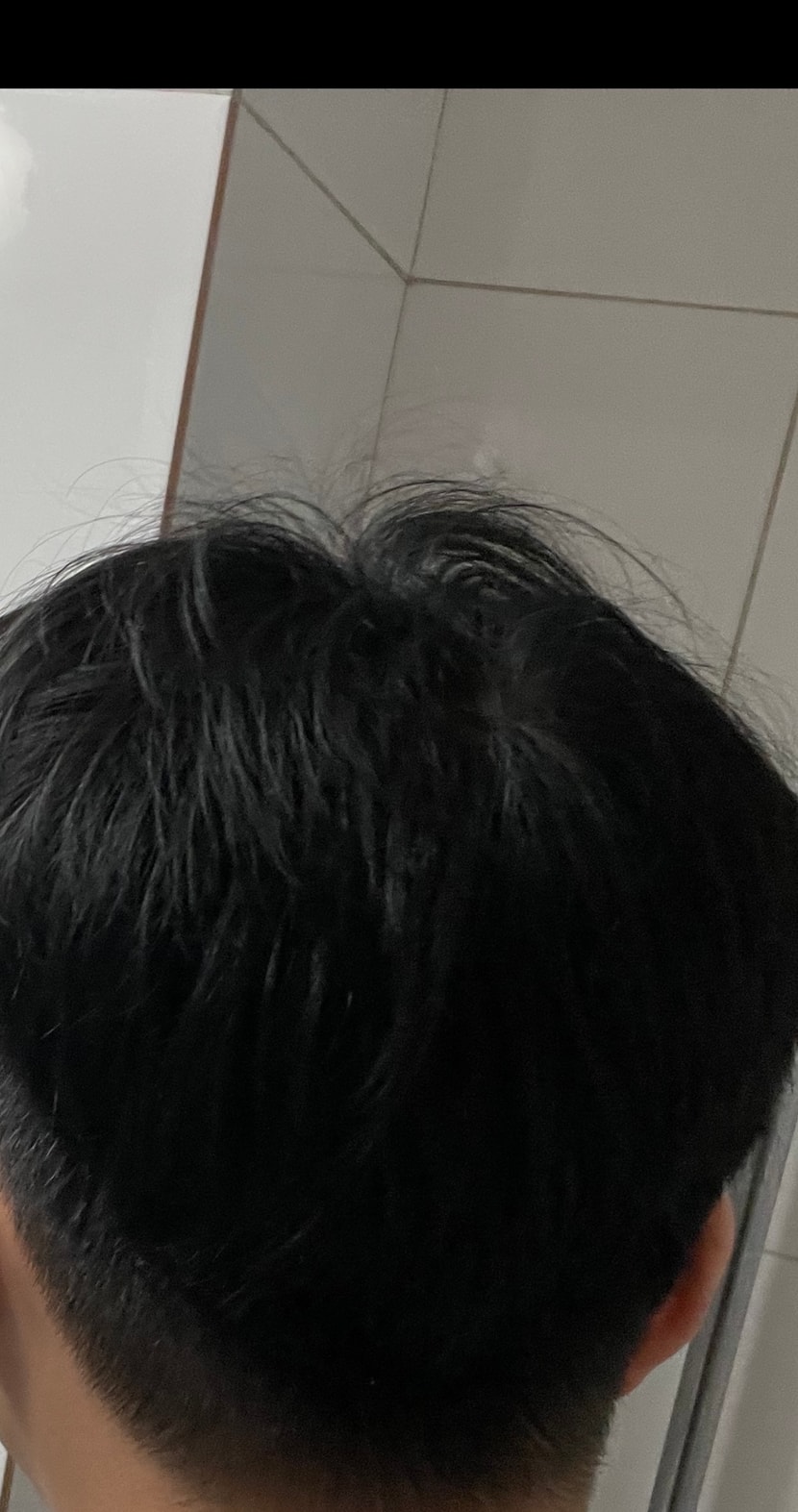 수술 후 뒷머리
