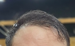 이식후 사진