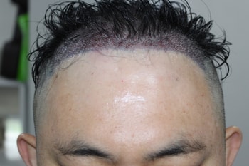 수술당일 정면