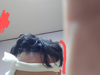 집와서 위생모 벗음. 지금 이식부위 건들면 안대서 나중에 사진 올려드리겠습니다.