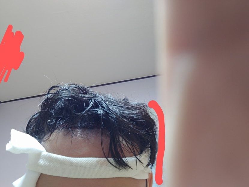 집와서 위생모 벗음. 지금 이식부위 건들면 안대서 나중에 사진 올려드리겠습니다.