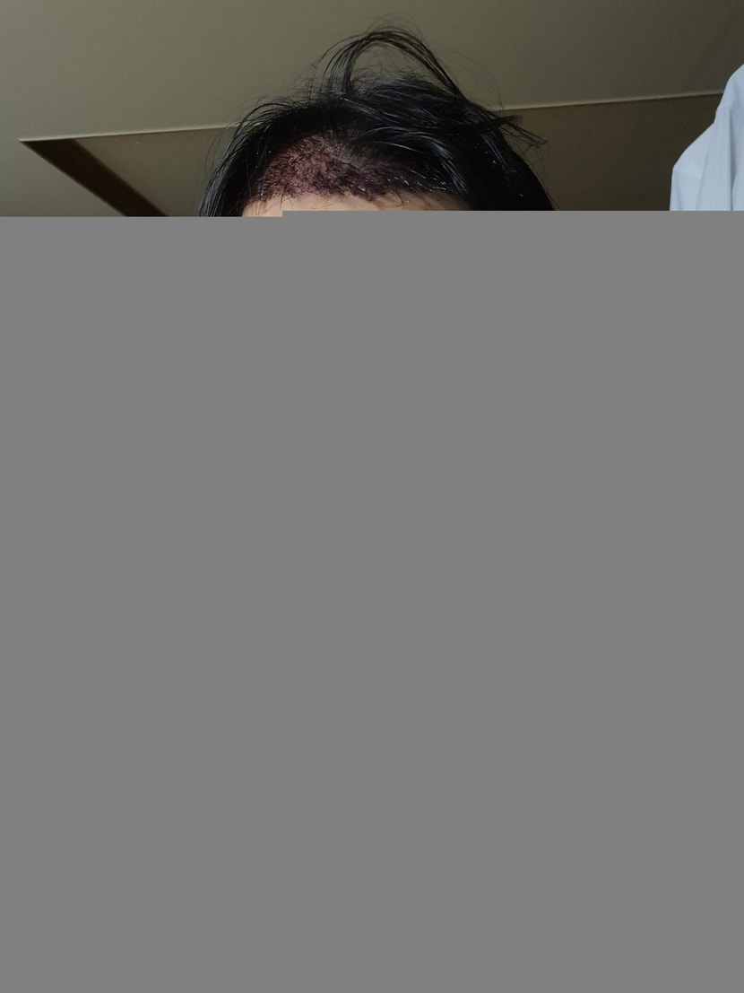 수술하고 나서 2틀 정도뒤에 샴푸하고 나온 사진입니다ㅎㅎ