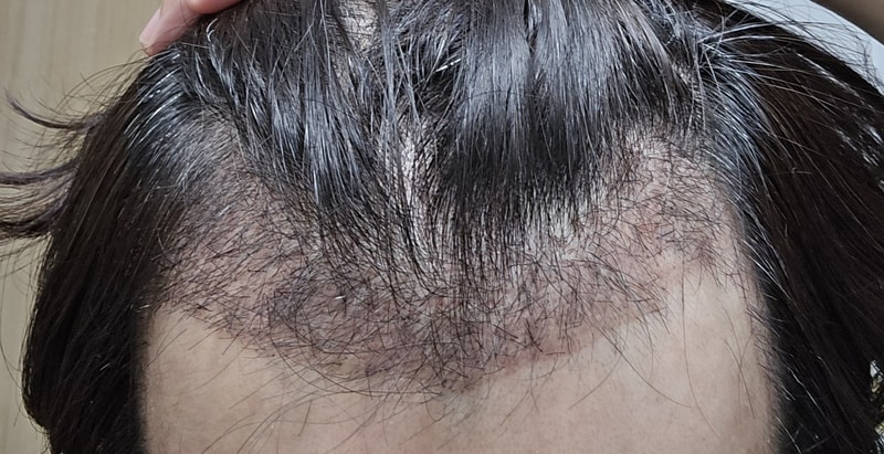 Non-Cutting M-shaped Transplantation Review