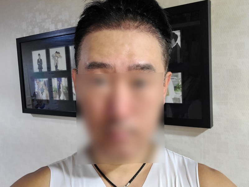 DA모발이식 혼용 4200모(절개2500모+비절개 박스컷1700모) 한달차 후기