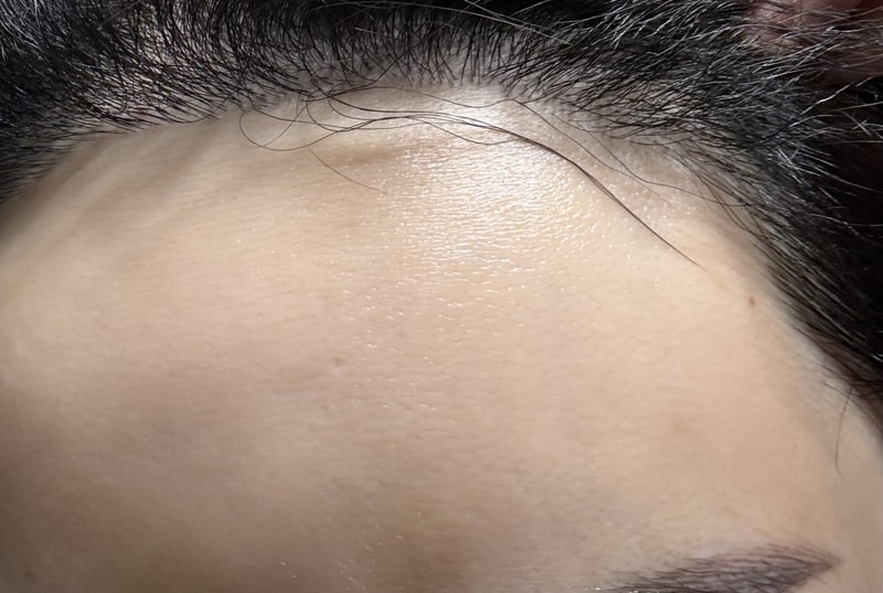 Hairline Hair Transplantation 7 Months